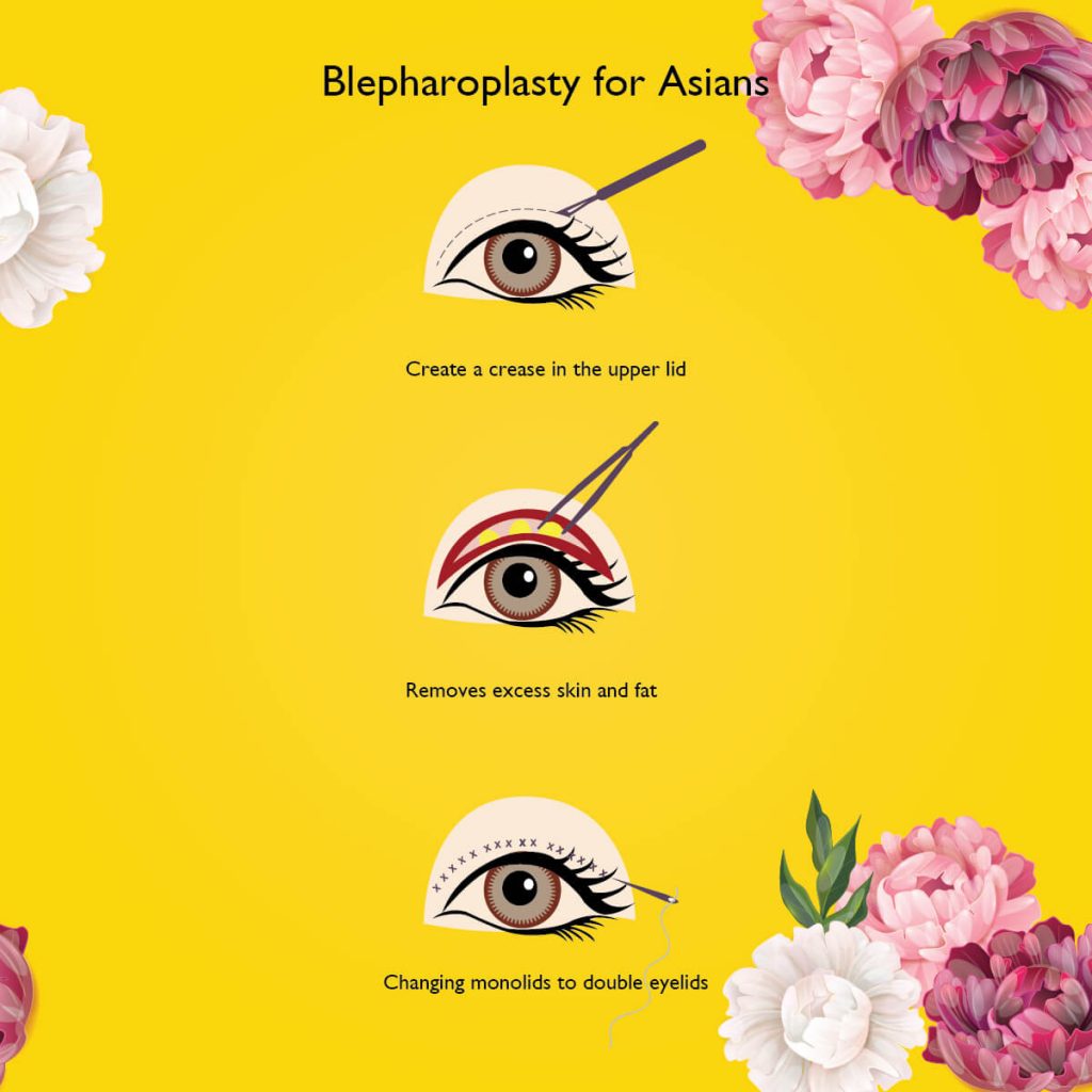 An Eye Obsession All You Need To Know About Cosmetic Eye Surgery