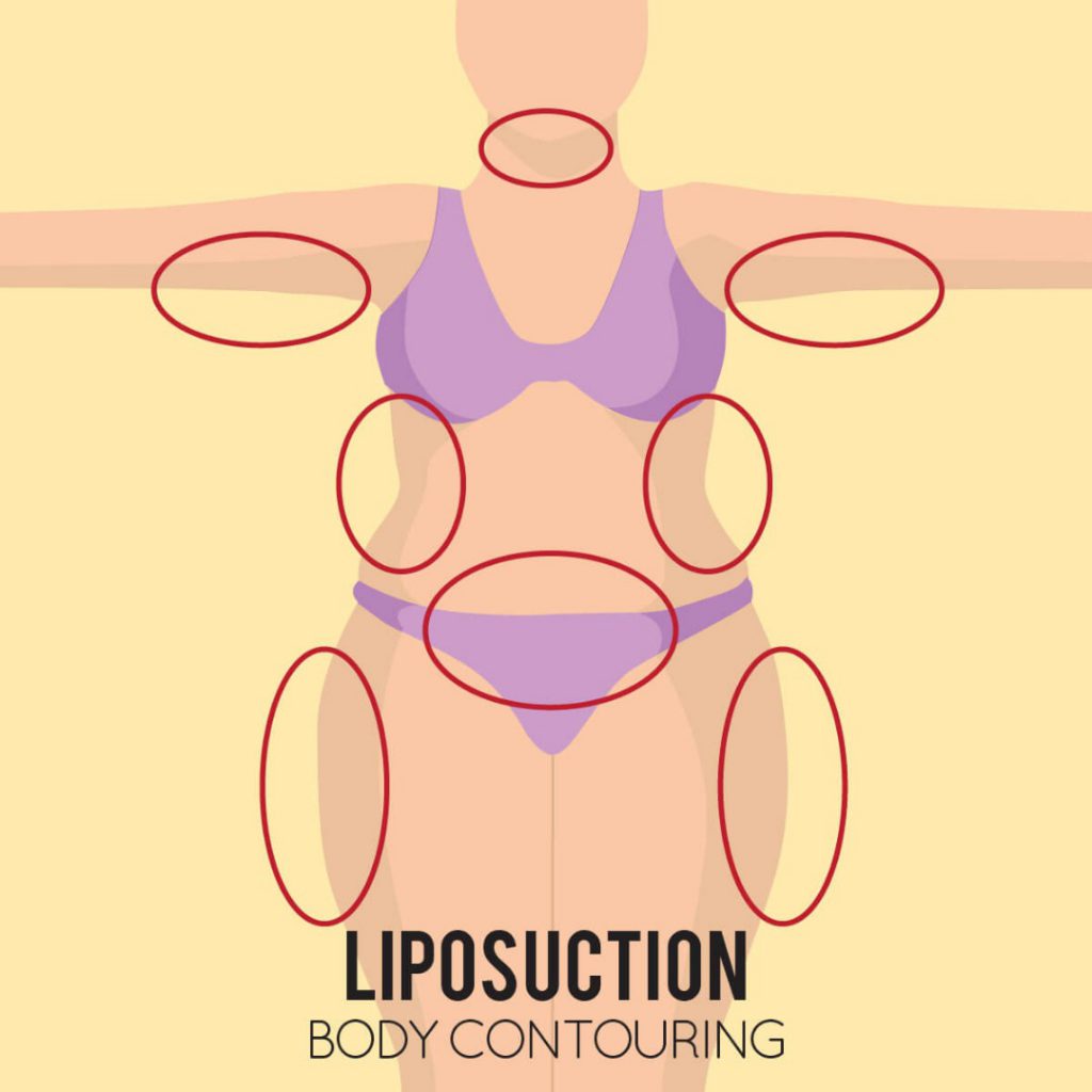Liposuction: Get Your Excess Fat Sucked Out