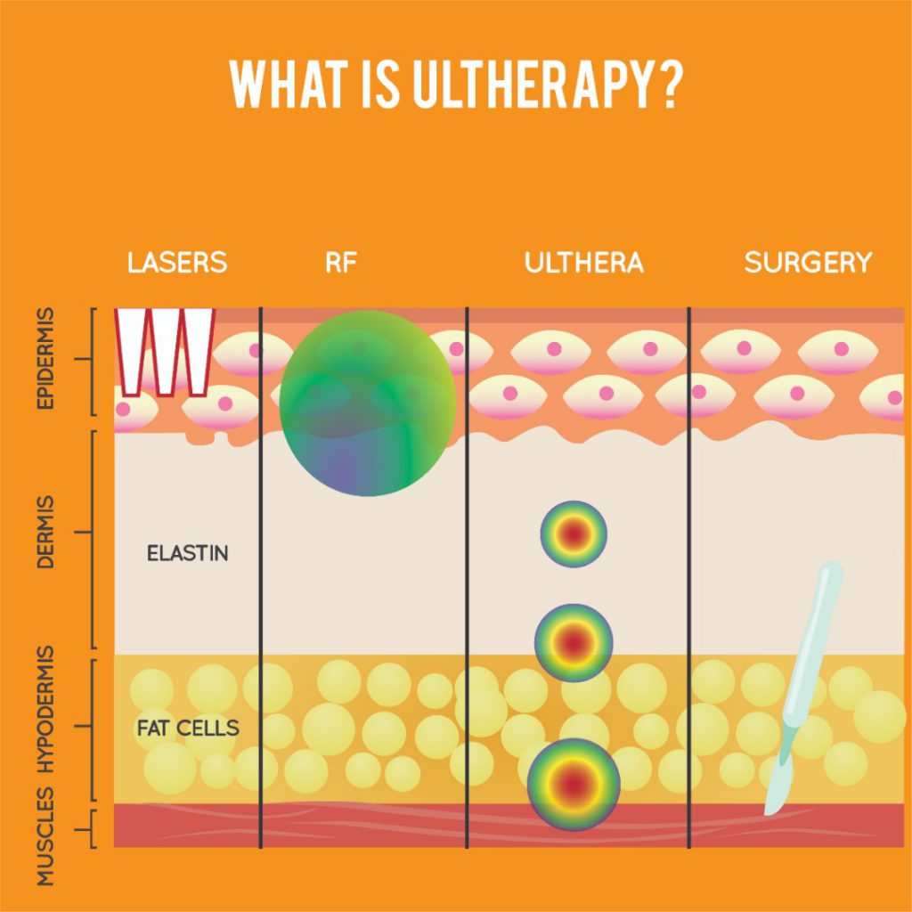 Ultherapy®: Be Your Best Self Again