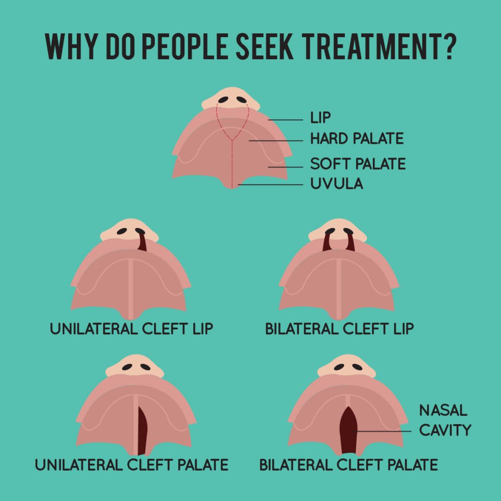 Cleft Lip Palate Beverly Wilshire Medical