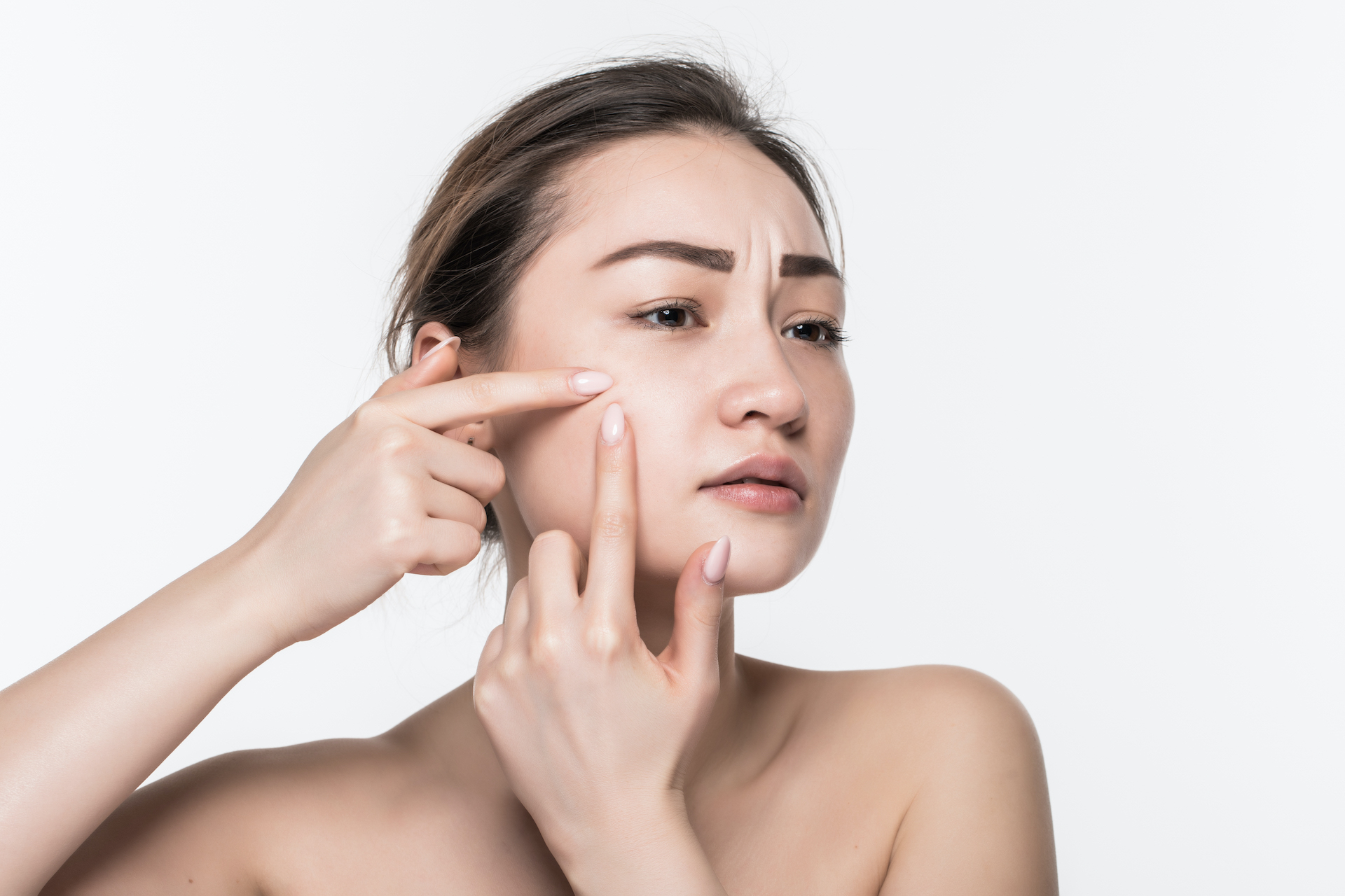 acne and acne solution