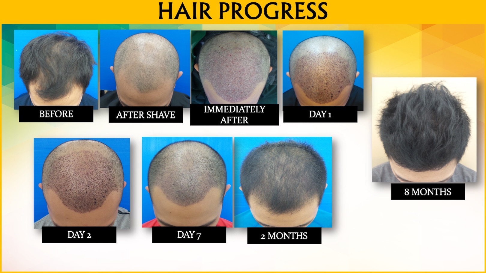 Fue Hair Transplant Malaysia | Hair Transplant KL, Malaysia Fue Hair Transplant Malaysia | Hair Transplant KL, Malaysia
