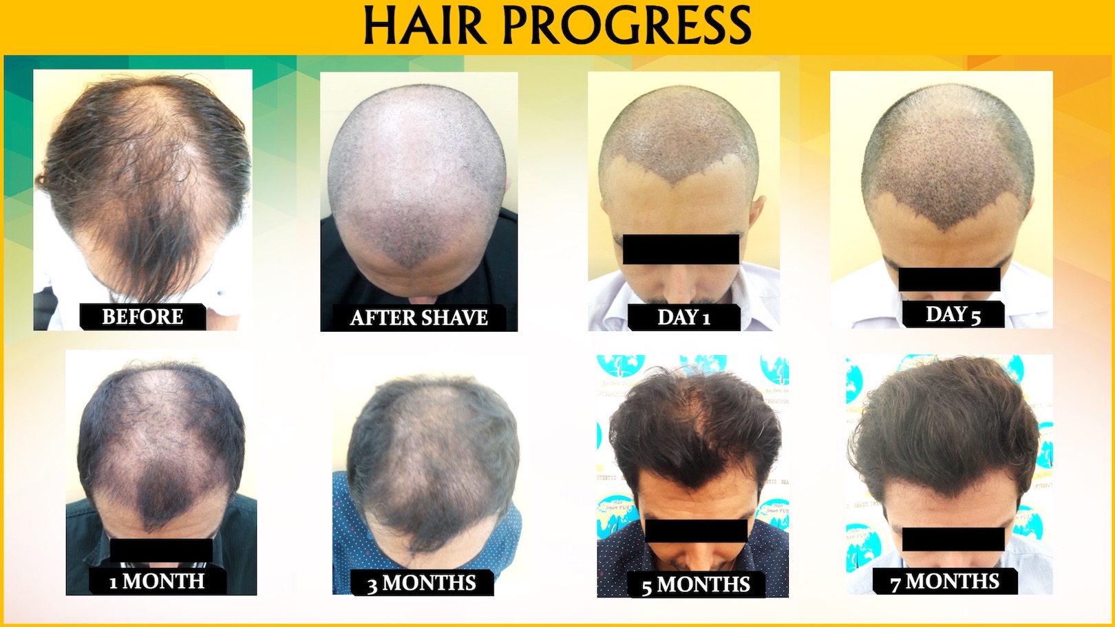 Fue Hair Transplant Malaysia | Hair Transplant KL, Malaysia