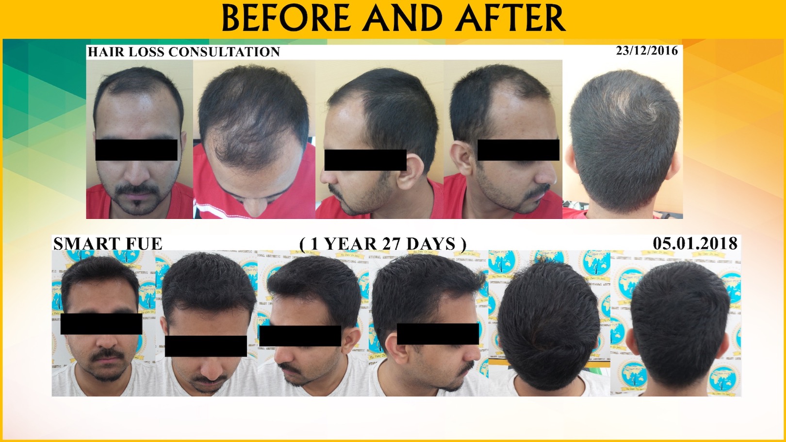 Fue Hair Transplant Malaysia | Hair Transplant KL, Malaysia