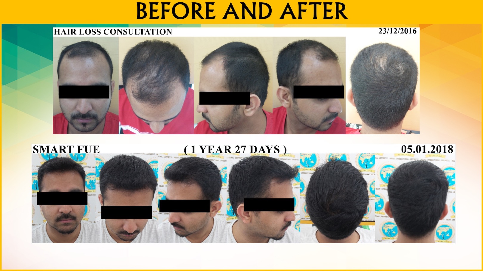 Fue Hair Transplant Malaysia | Hair Transplant KL, Malaysia Fue Hair Transplant Malaysia | Hair Transplant KL, Malaysia